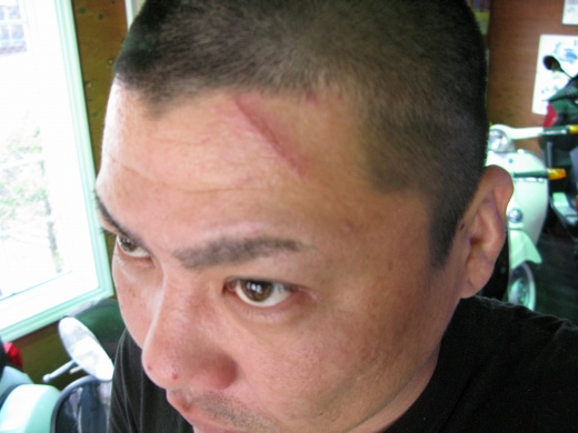 額にジッパー傷を負った男性のアップ写真、痛々しさと笑いが同居